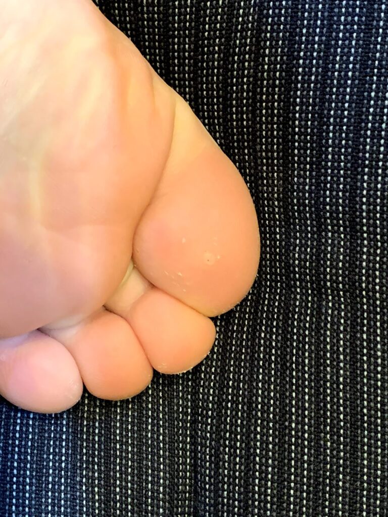 足の指にできたイボ
